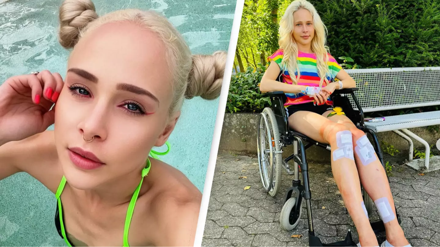 Woman opens up after completing $162,000 ‘Frankenstein’ surgery that extended her legs by 5.5 inches