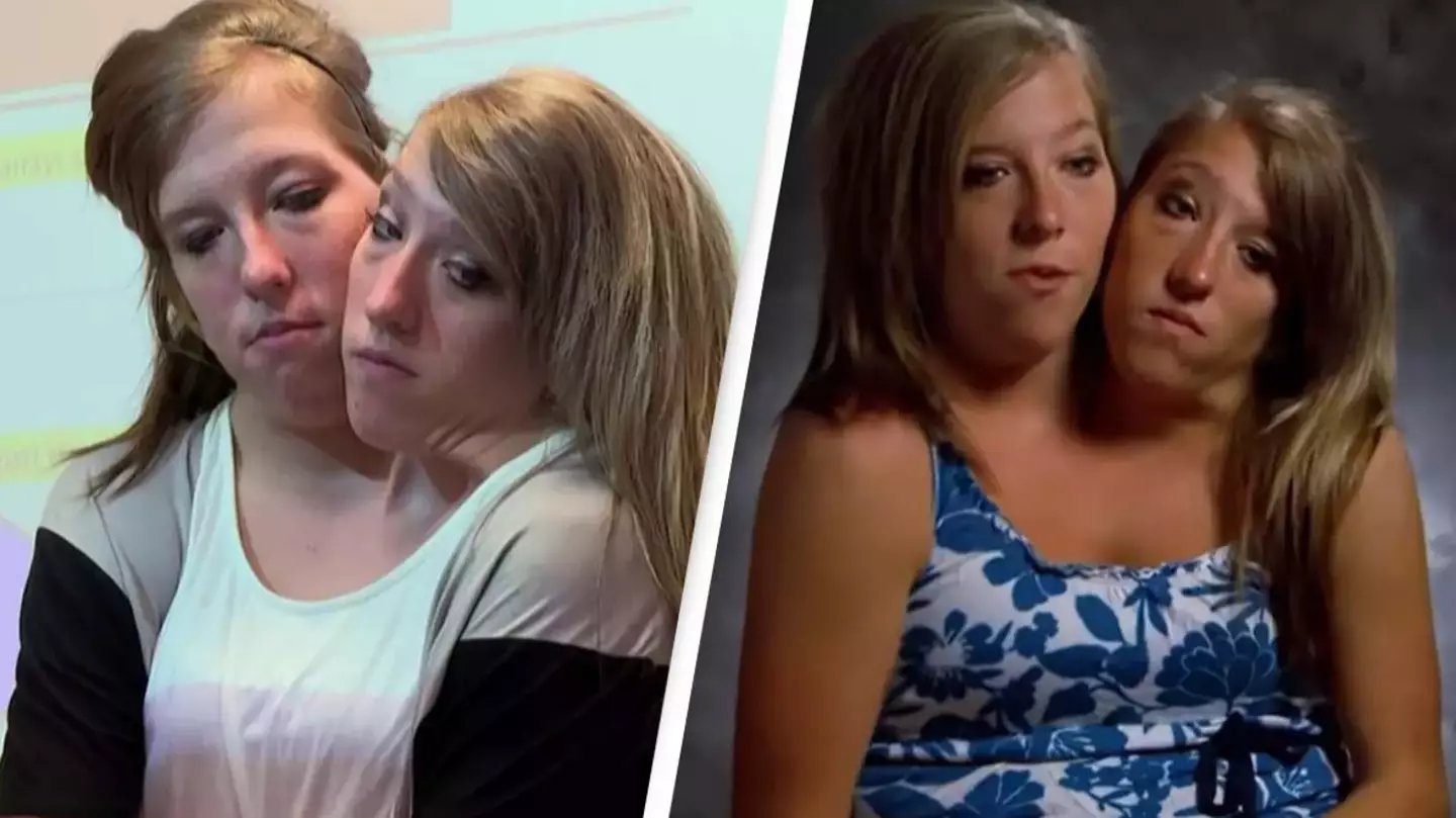 Conjoined twins opened up on what their life was like after becoming teachers