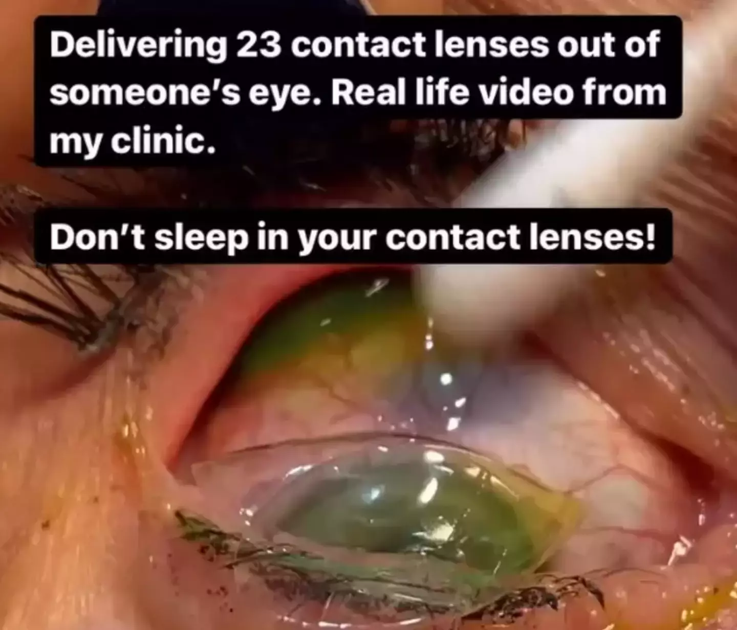 The patient went to bed with her contact lenses in on numerous occasions, causing a skin-crawling build up. (Instagram/@california_eye_associates)