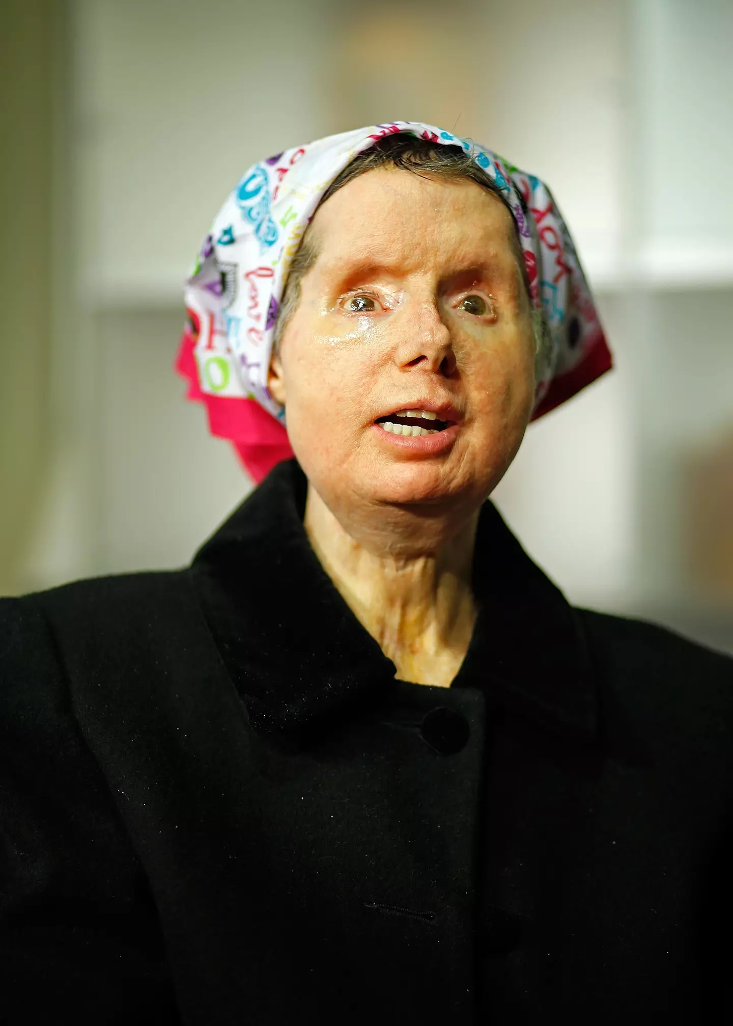 Charla Nash was left with life-changing injuries, resulting in her needing a full face transplant. (Nancy Lane/MediaNews Group/Boston Herald via Getty Images)