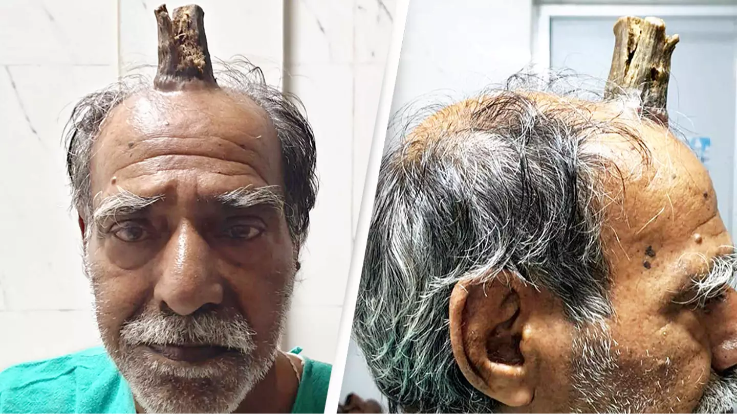 Man's horror as four-inch 'devil horn' grows out of his head