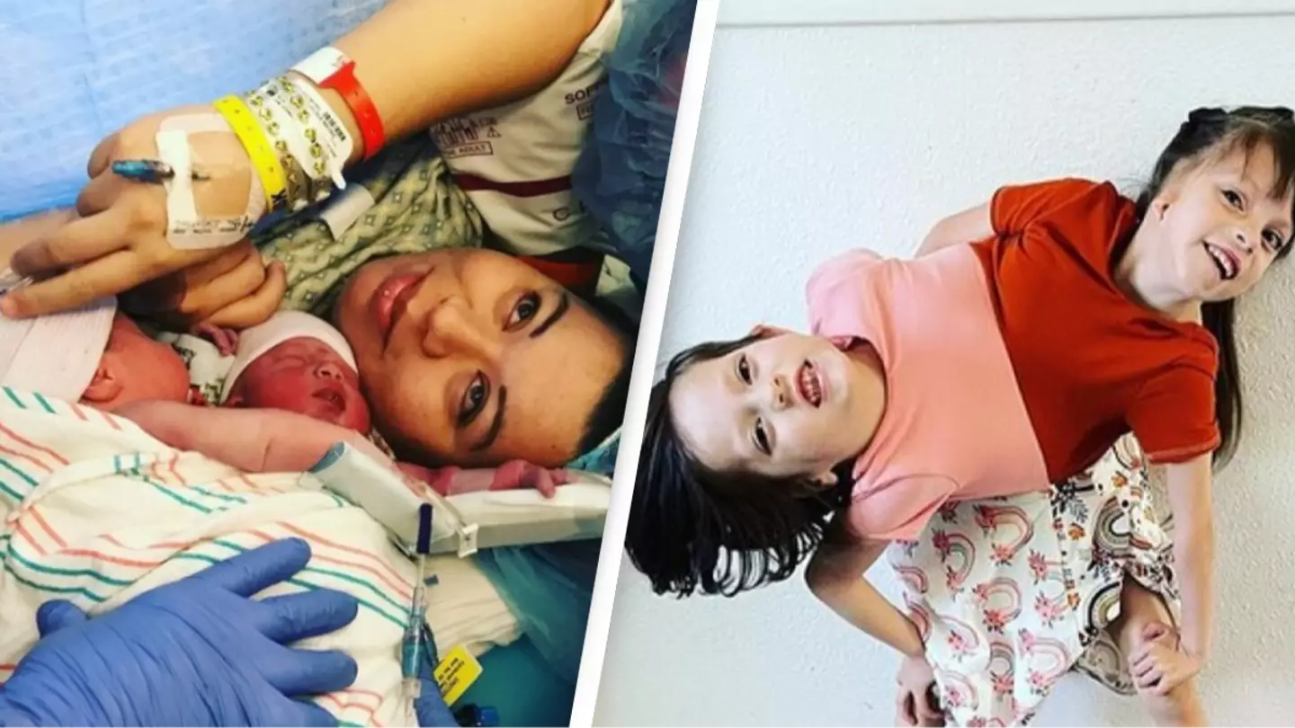 Parents of conjoined twins who were given less than 24 hours to live explain why they won’t separate them