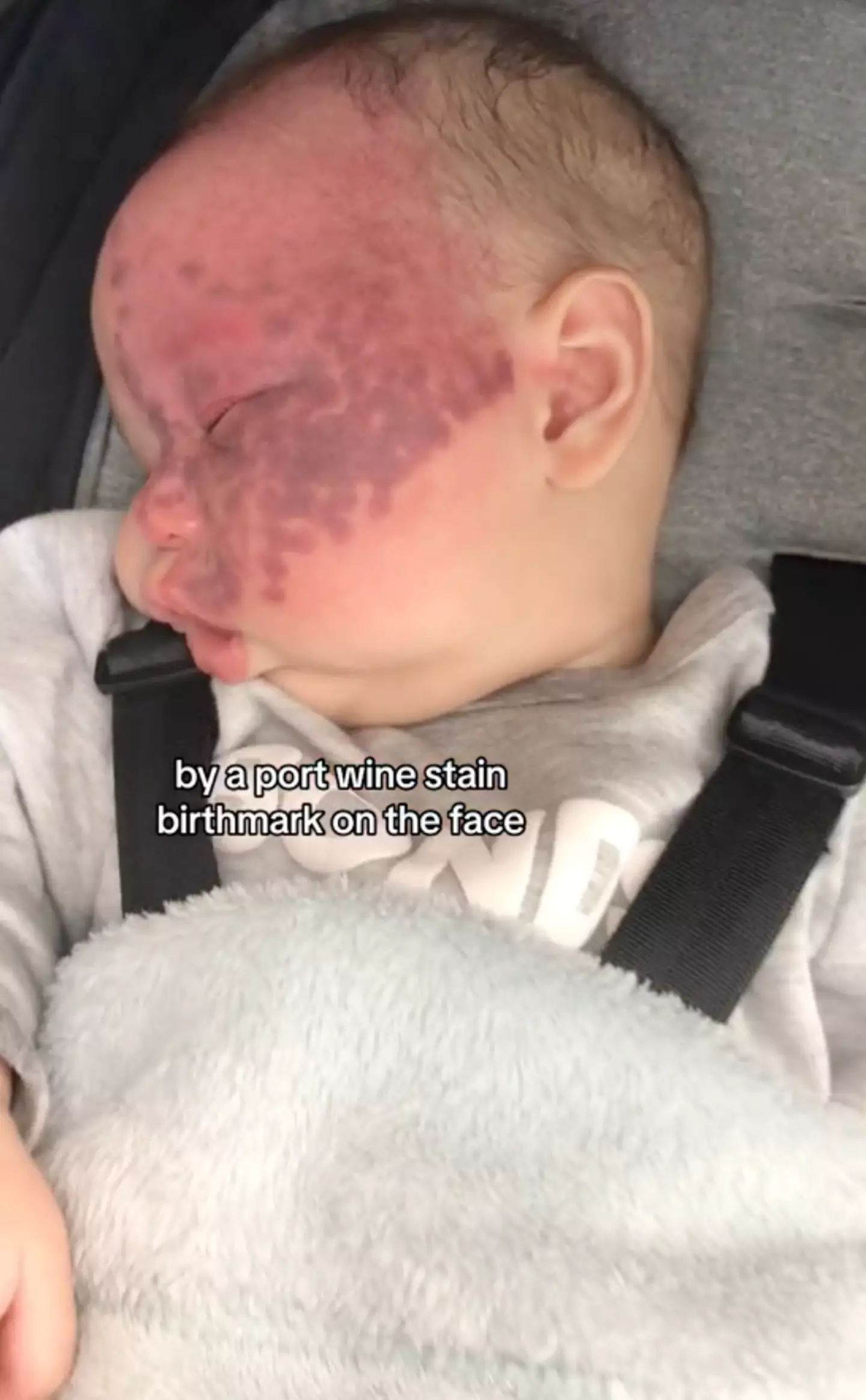 Baby Kingsley was born with a port-wine stain birthmark. (TikTok/@brookecyn)