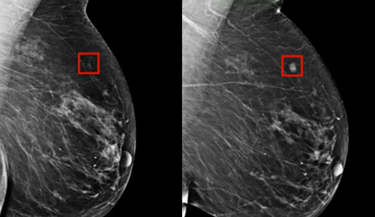 The image on the left shows something the AI identified as cancer, on the right is four years later as it started to develop.