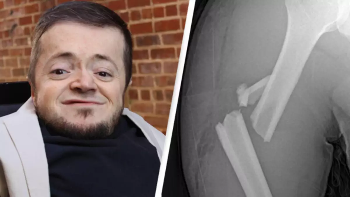 Man reveals harsh reality of living with rare disease that causes broken bones when he sneezes
