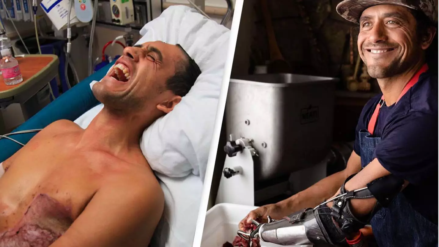 Incredible Story Of ‘Bionic Chef’ Who Was Electrocuted By A Black Bear