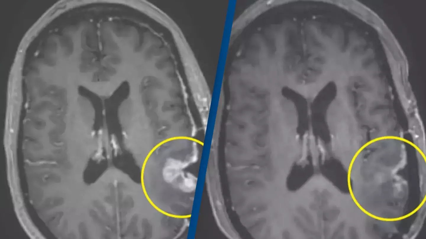 Remarkable cancer breakthrough shows woman's brain tumor almost disappear in just five days