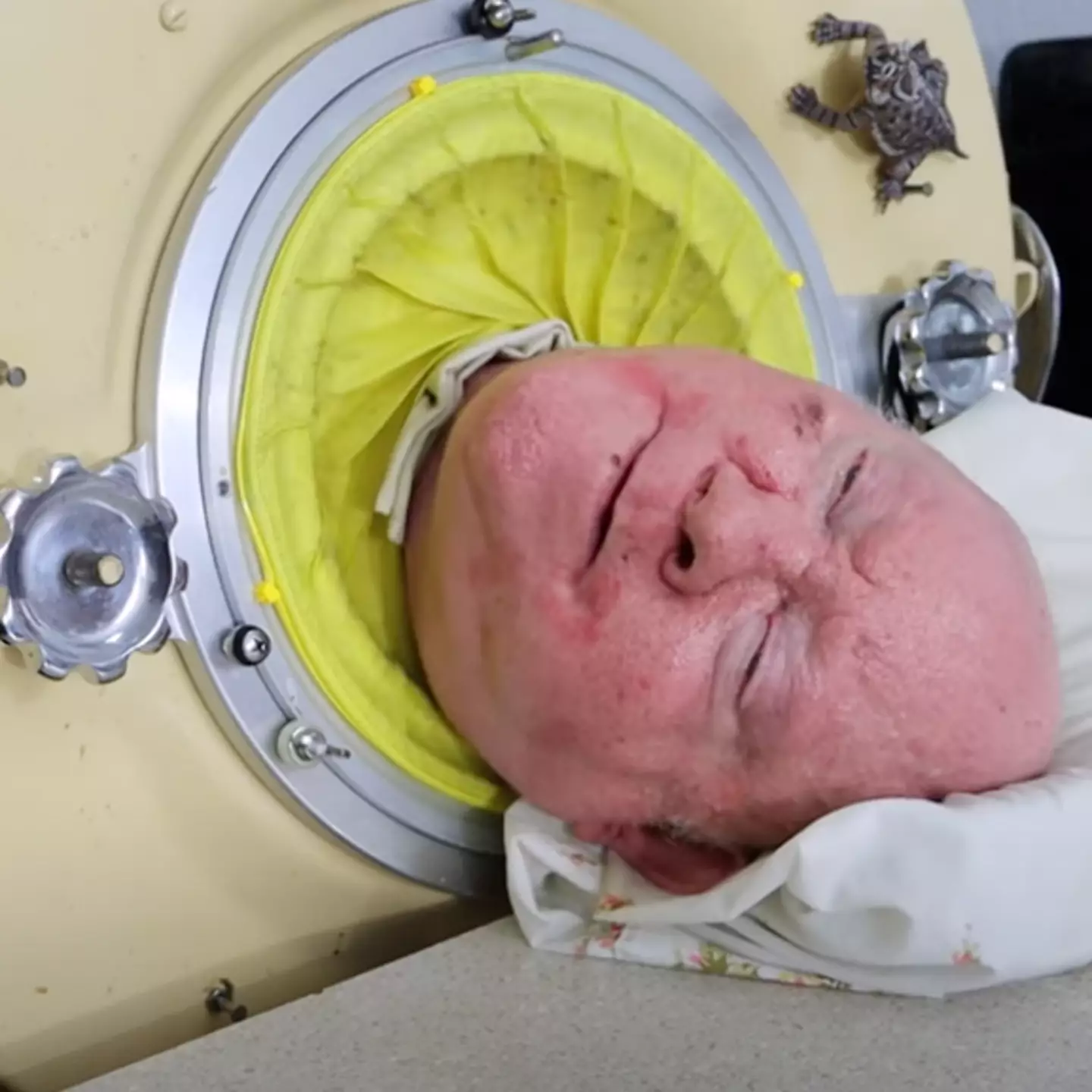 Man who’s survived inside iron lung for 72 years shares his incredible story on TikTok