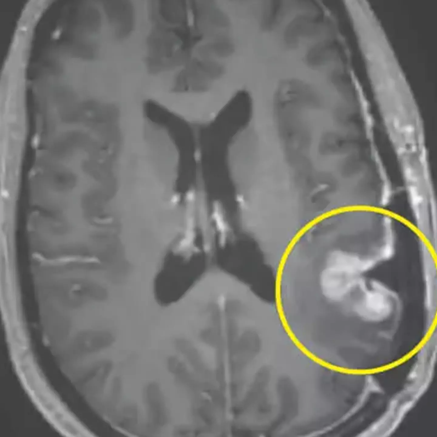 Incredible cancer breakthrough sees woman's brain tumor almost disappear in just five days