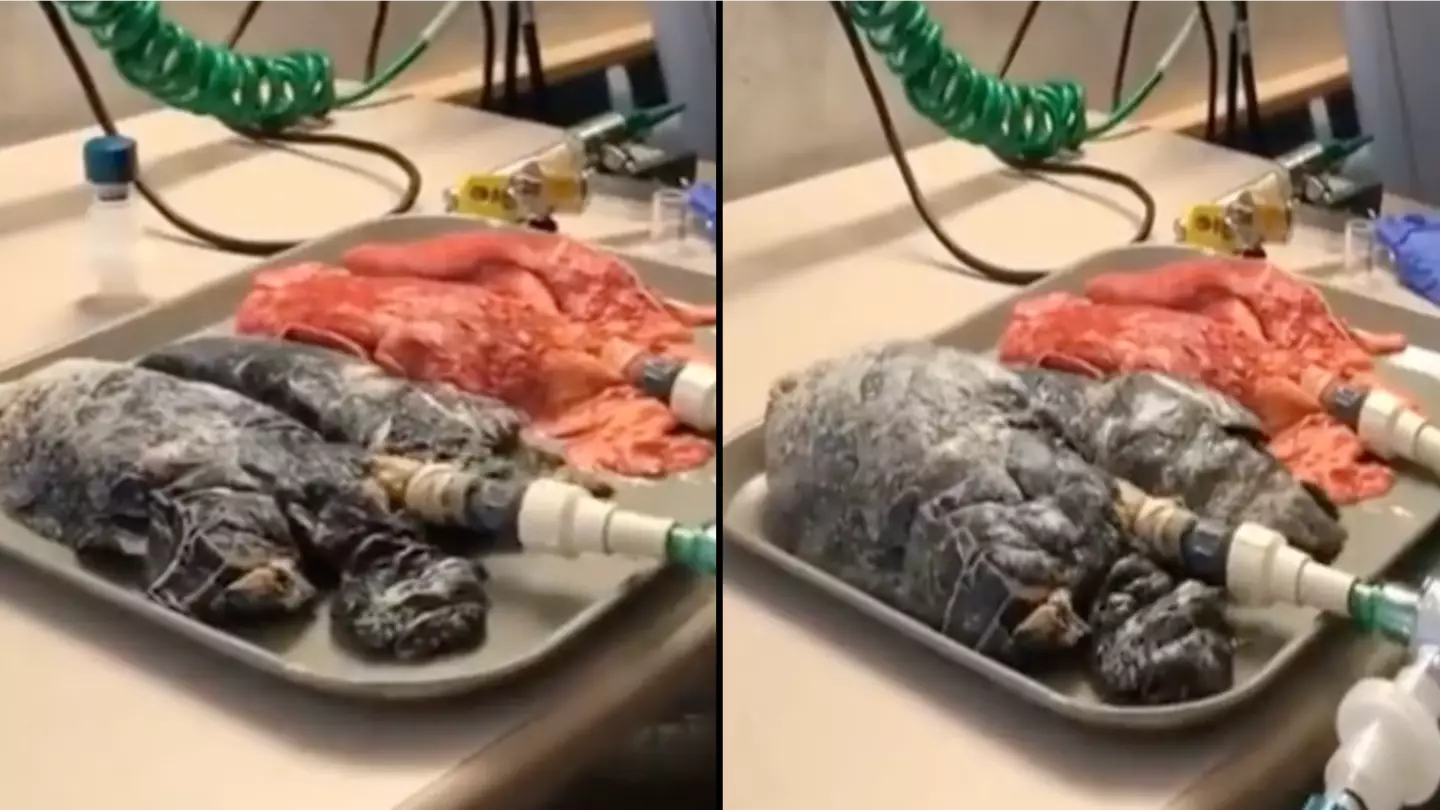 Horrifying video shows what lungs of a 20 year smoker look like when breathing