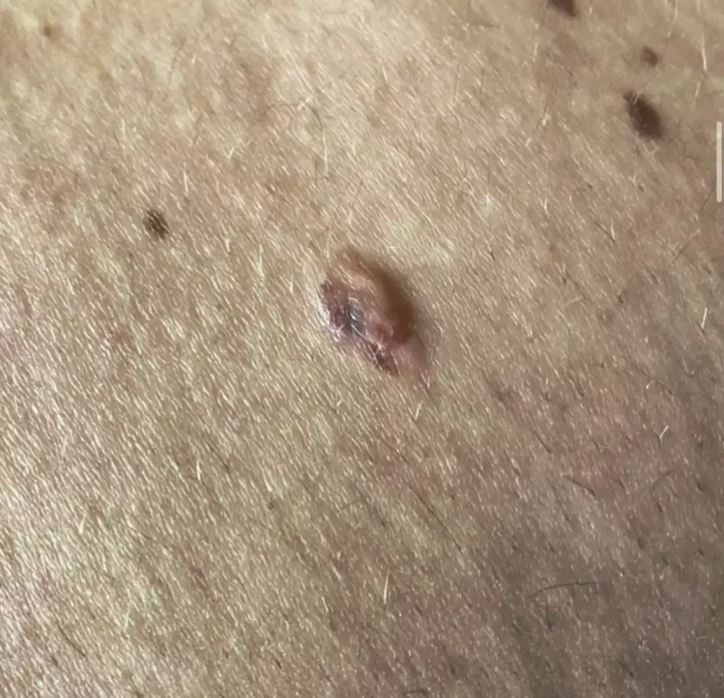 Jak noticed a mole that started to bleed.