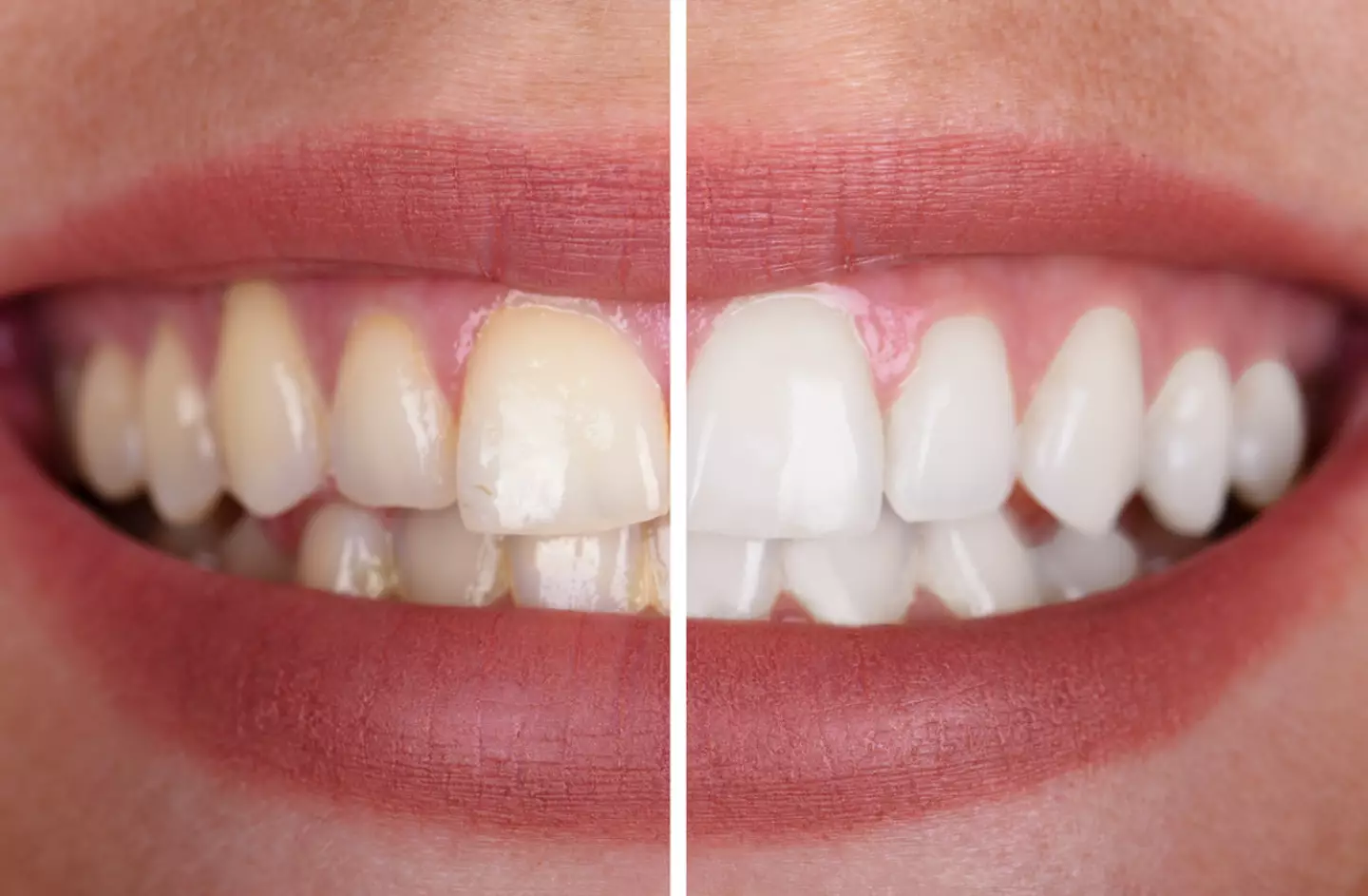 Yellow vs white teeth. (Getty Stock Images)