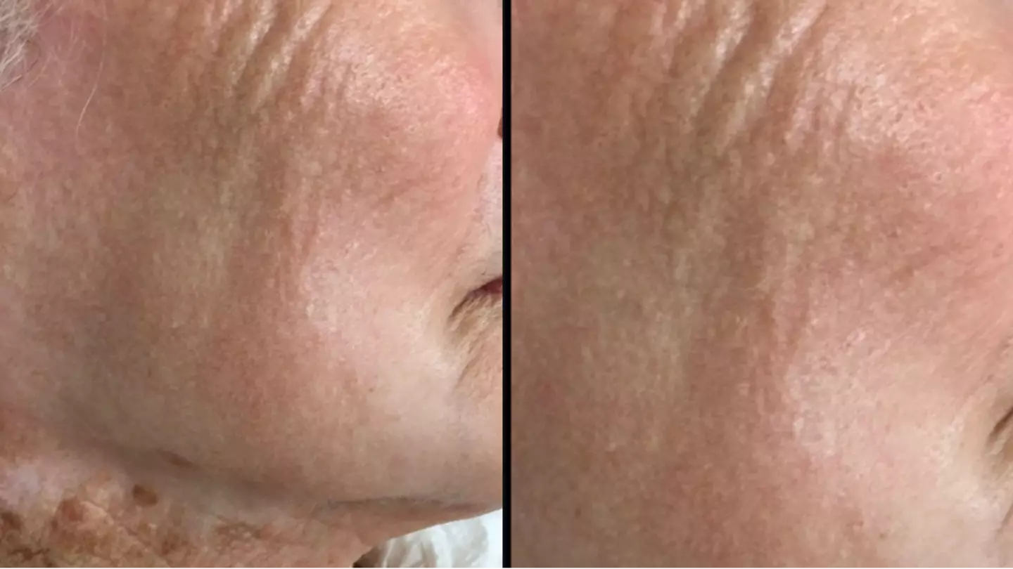 Woman who only wore sun protection on her face for 40 years shows shocking impact it had on her neck