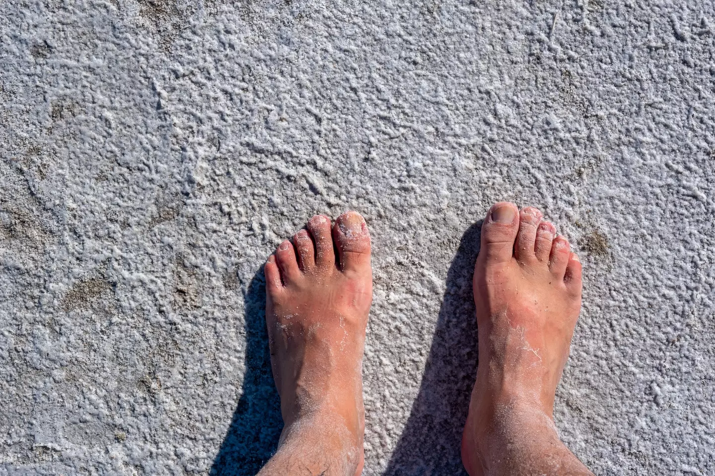 Crusty feet might mean something more than just needed cream. (Getty Stock)