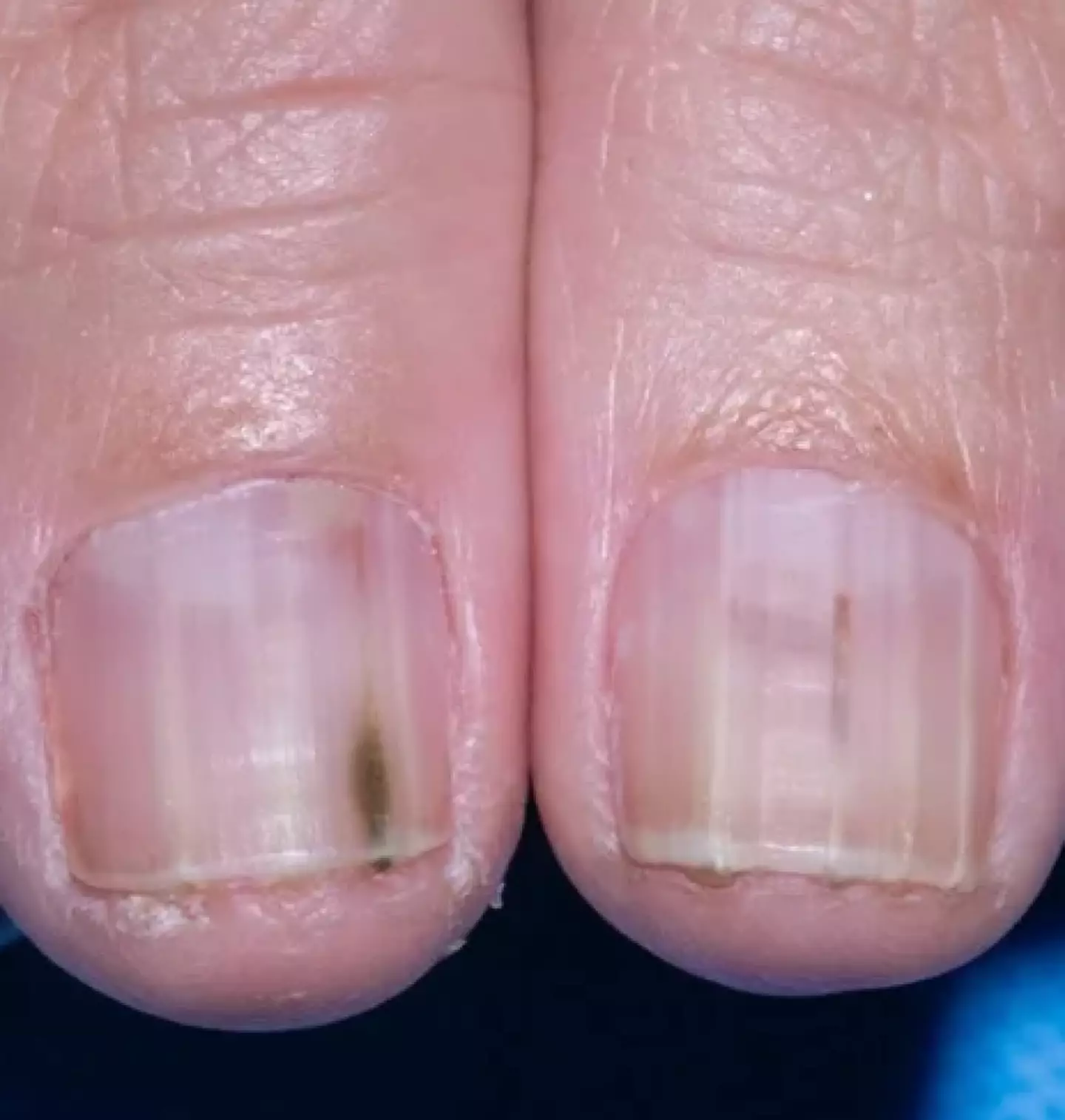 Stripes in the nails are something to look out for (JAMA Network)