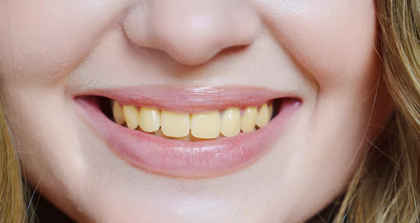 People hate having yellow teeth. (Getty Stock Images)
