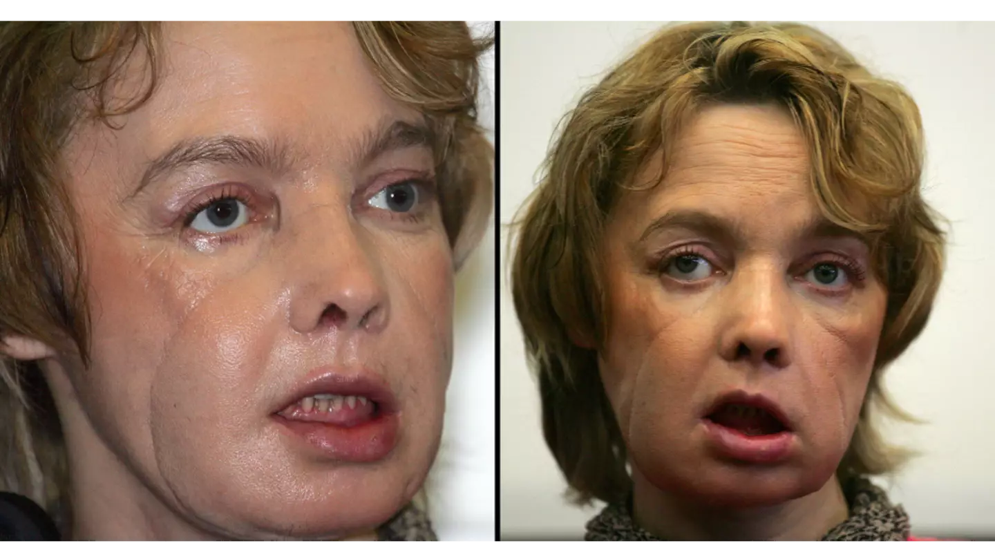 Woman who got world’s first face transplant suffered devastating consequences afterwards