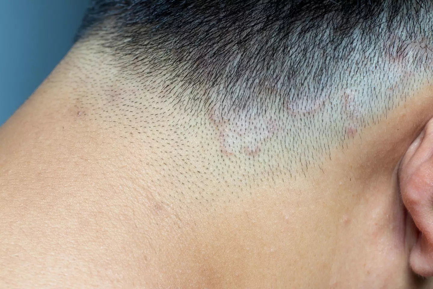 A parent has claimed that her child developed a ringworm infection after getting a skin fade (stock image).