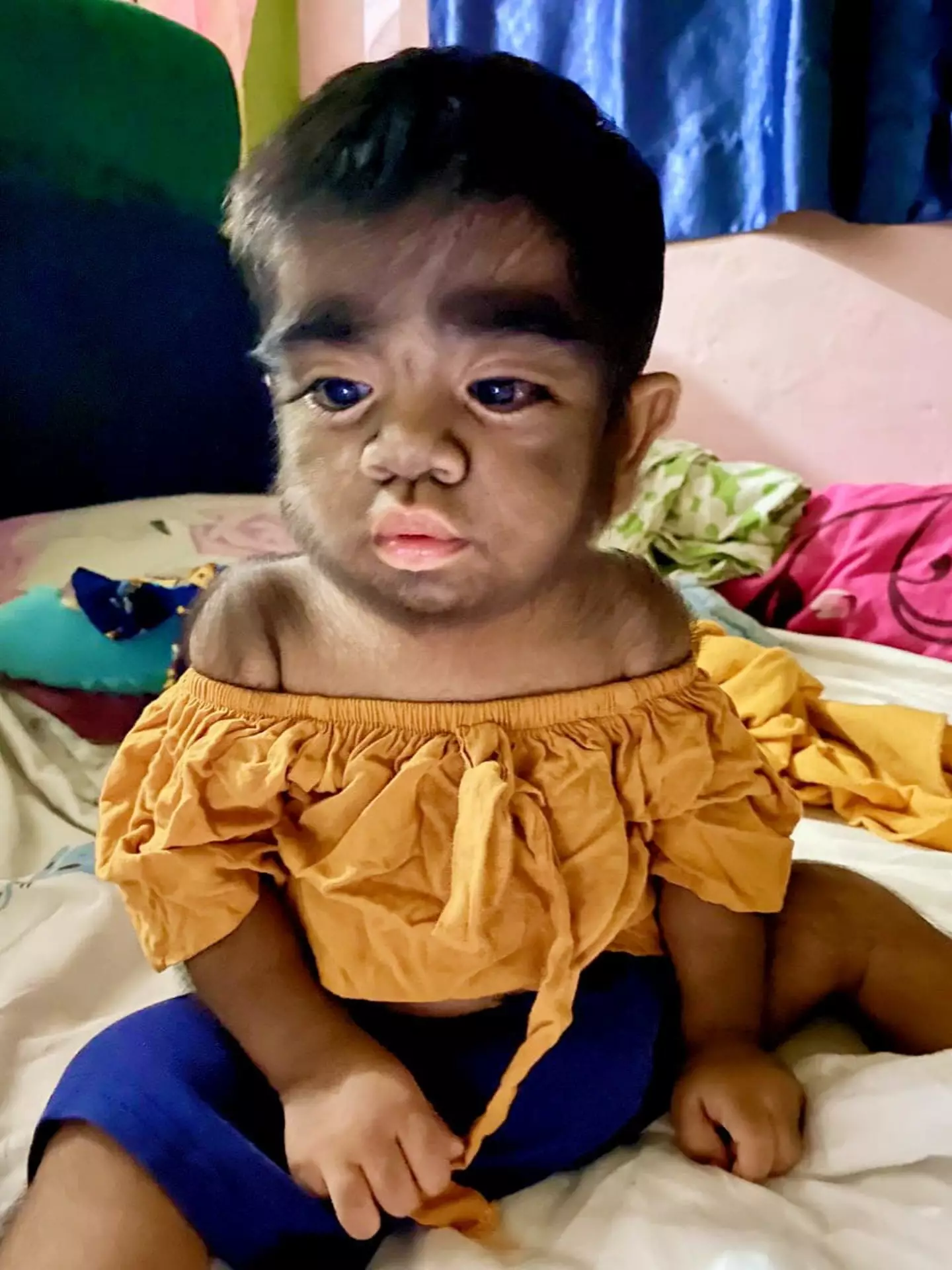 Two-year-old Jaren Gamongan has 'werewolf syndrome', which causes his face and body to be covered with hair. (ViralPress)