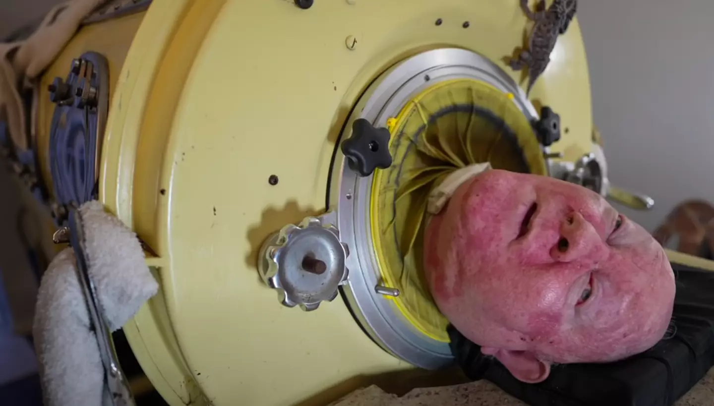 Paul has lived in an iron lung for over 65 years.