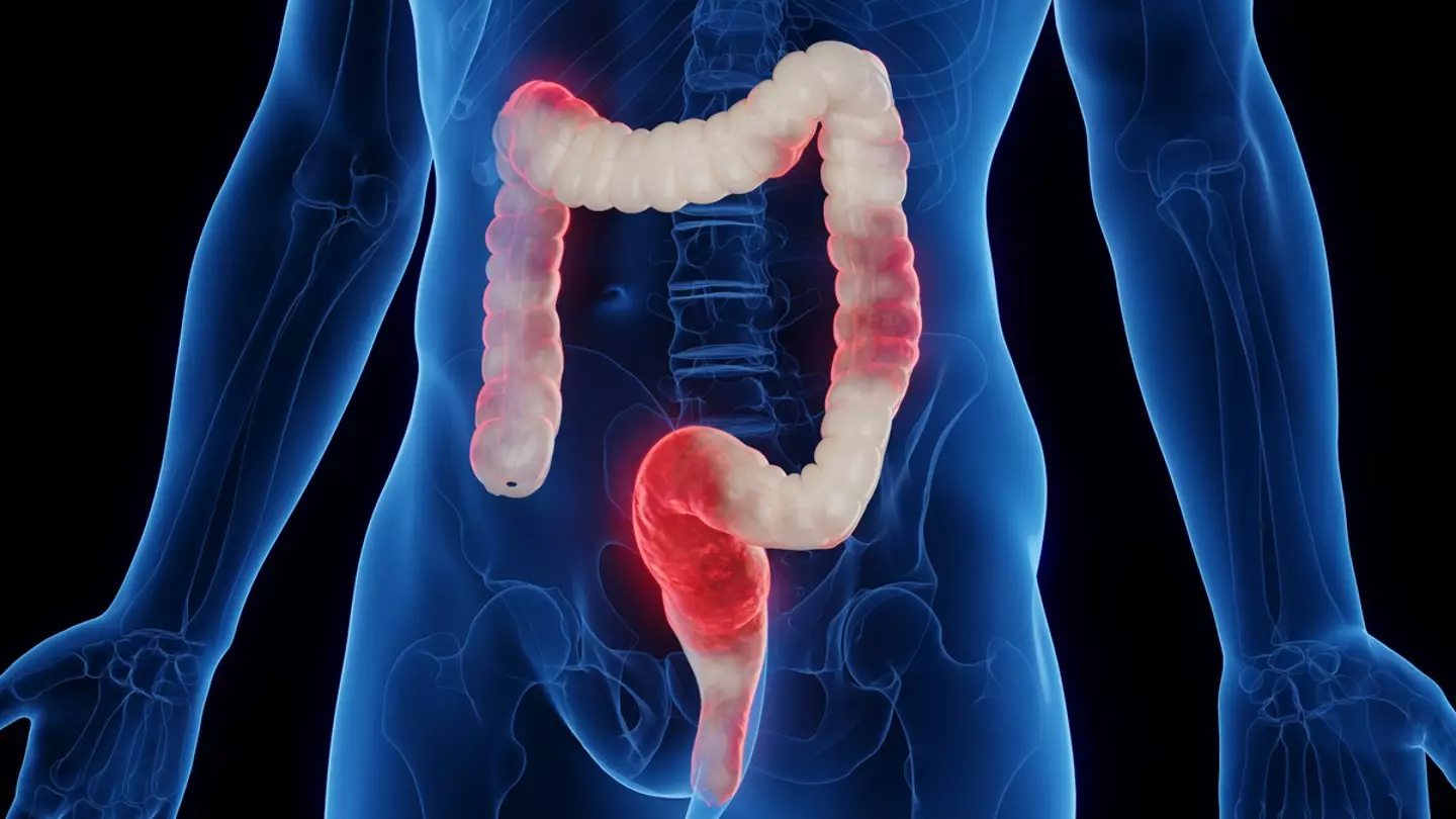 UK scientists have made a major breakthrough while investigating inflammatory bowel disease (Getty stock image)