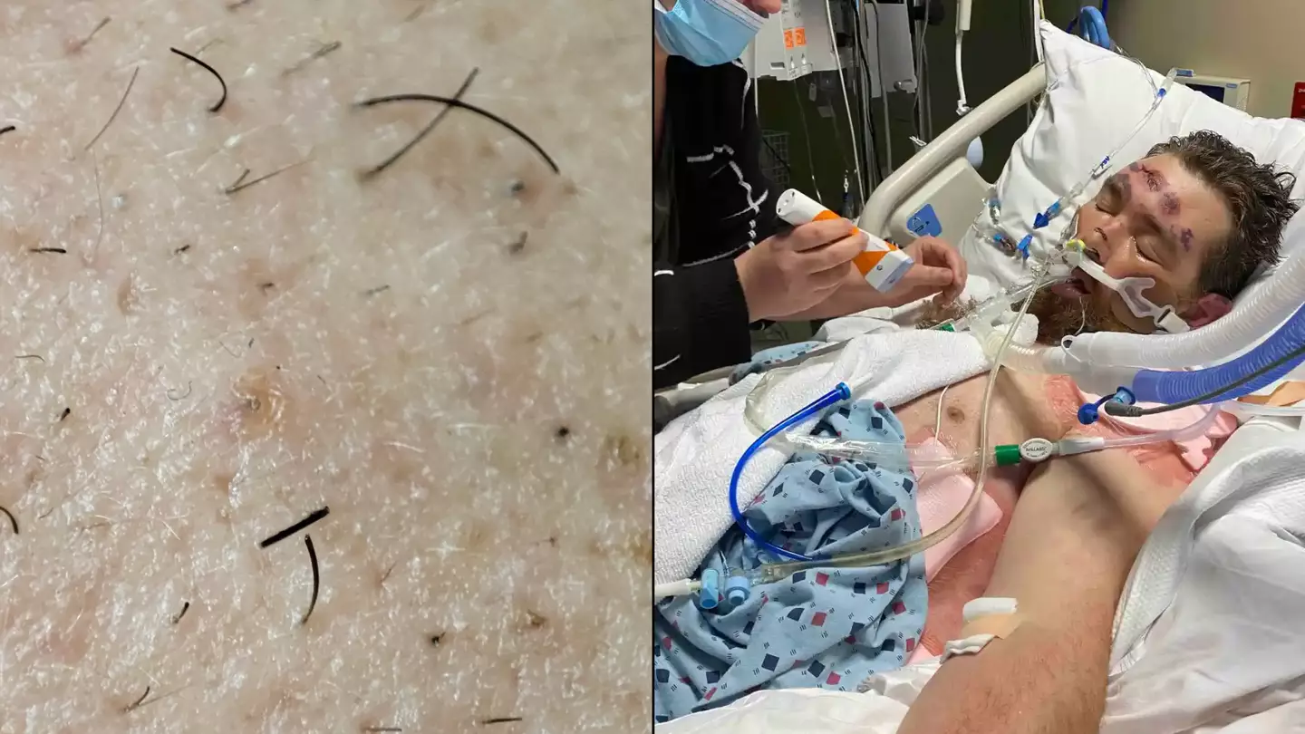 Official advice on pulling out ingrown hairs after man left in coma with low survival rate