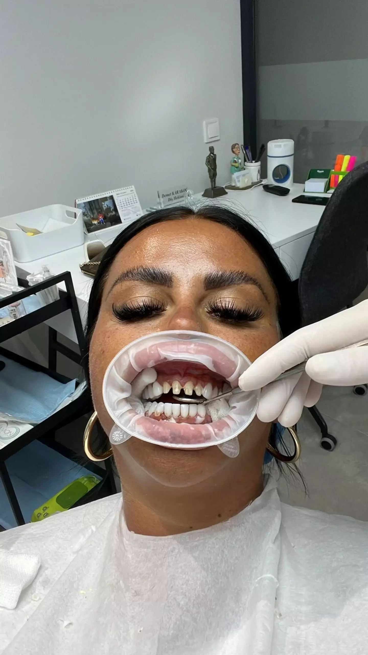 The couple opted to visit a private clinic for a cosmetic veneer procedure, which involves shaving down their teeth before fitting the new set of veneers over the top of them.
