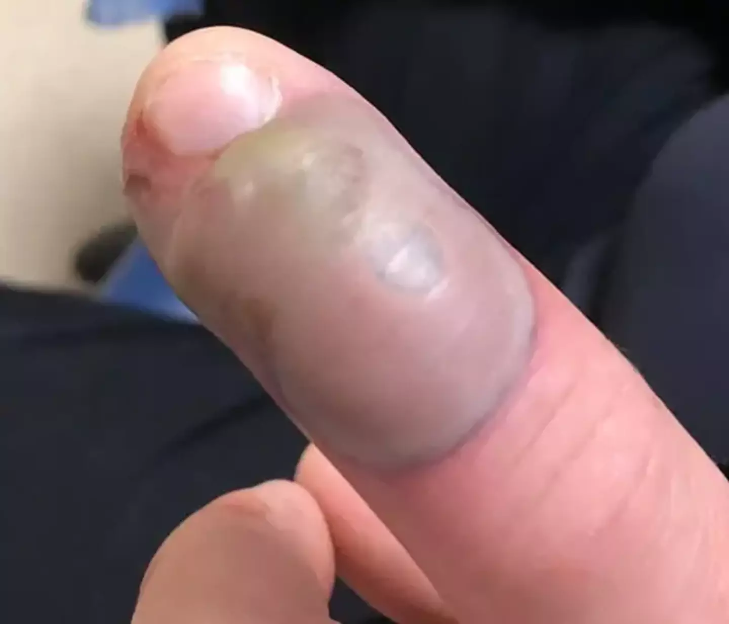 There are measures you can take to make sure your fingernails don't end up like this.