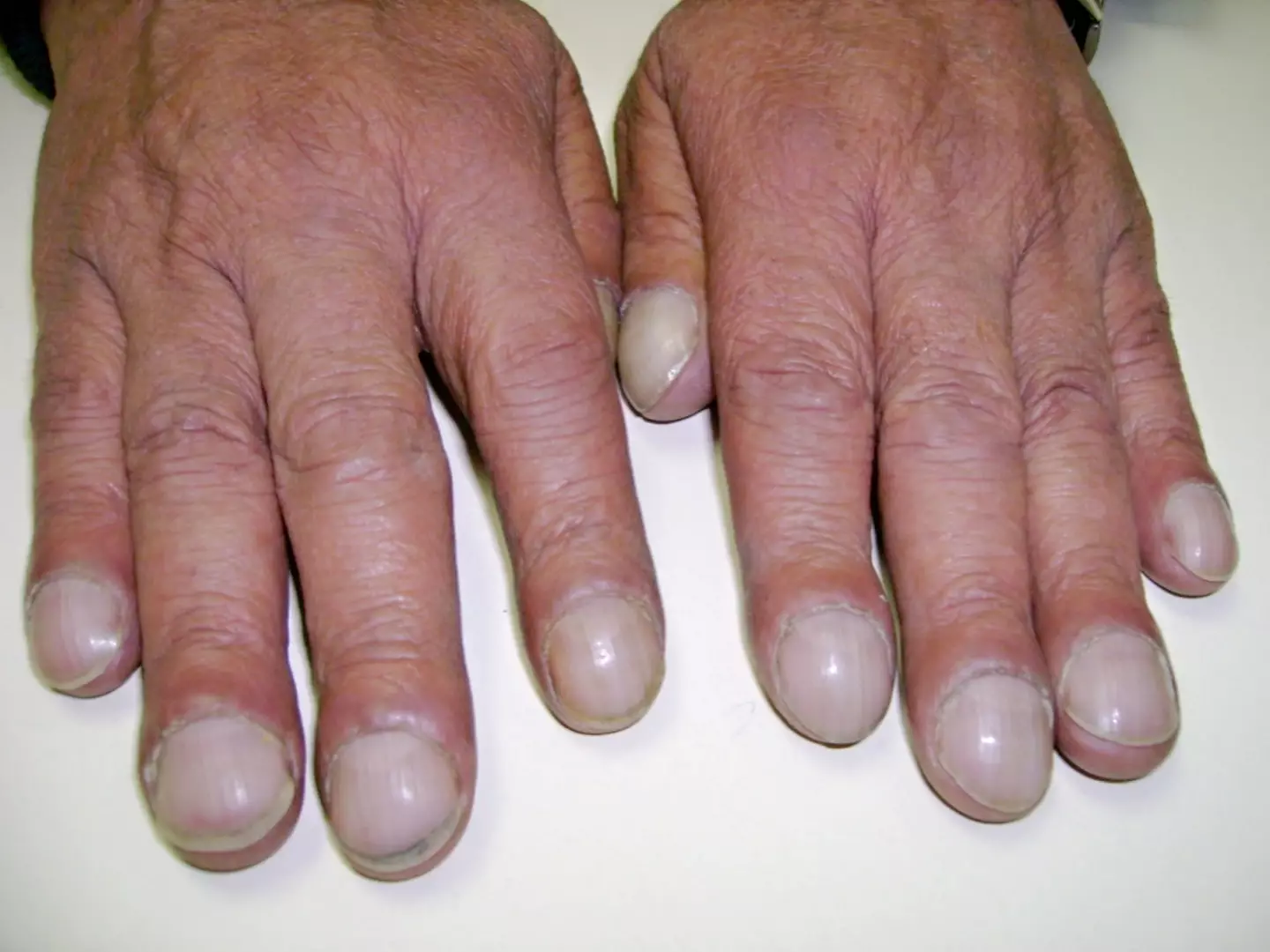 An example of finger clubbing, note the enlarged ends of the fingers and the curved nails. (Desherinka - Own work, CC BY-SA 4.0)