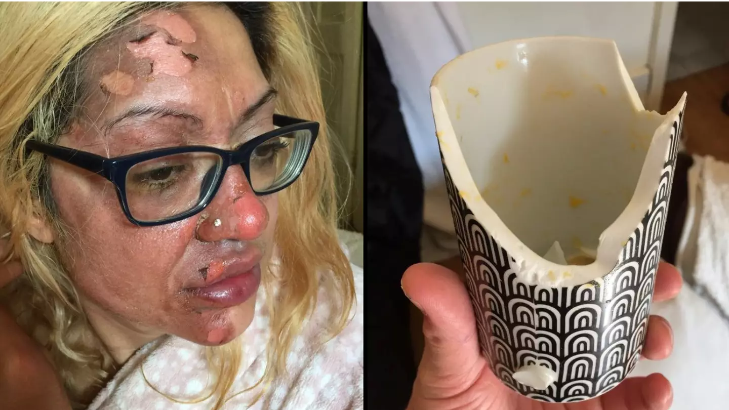 Mother left in 'absolute agony' after trying viral TikTok poached egg hack
