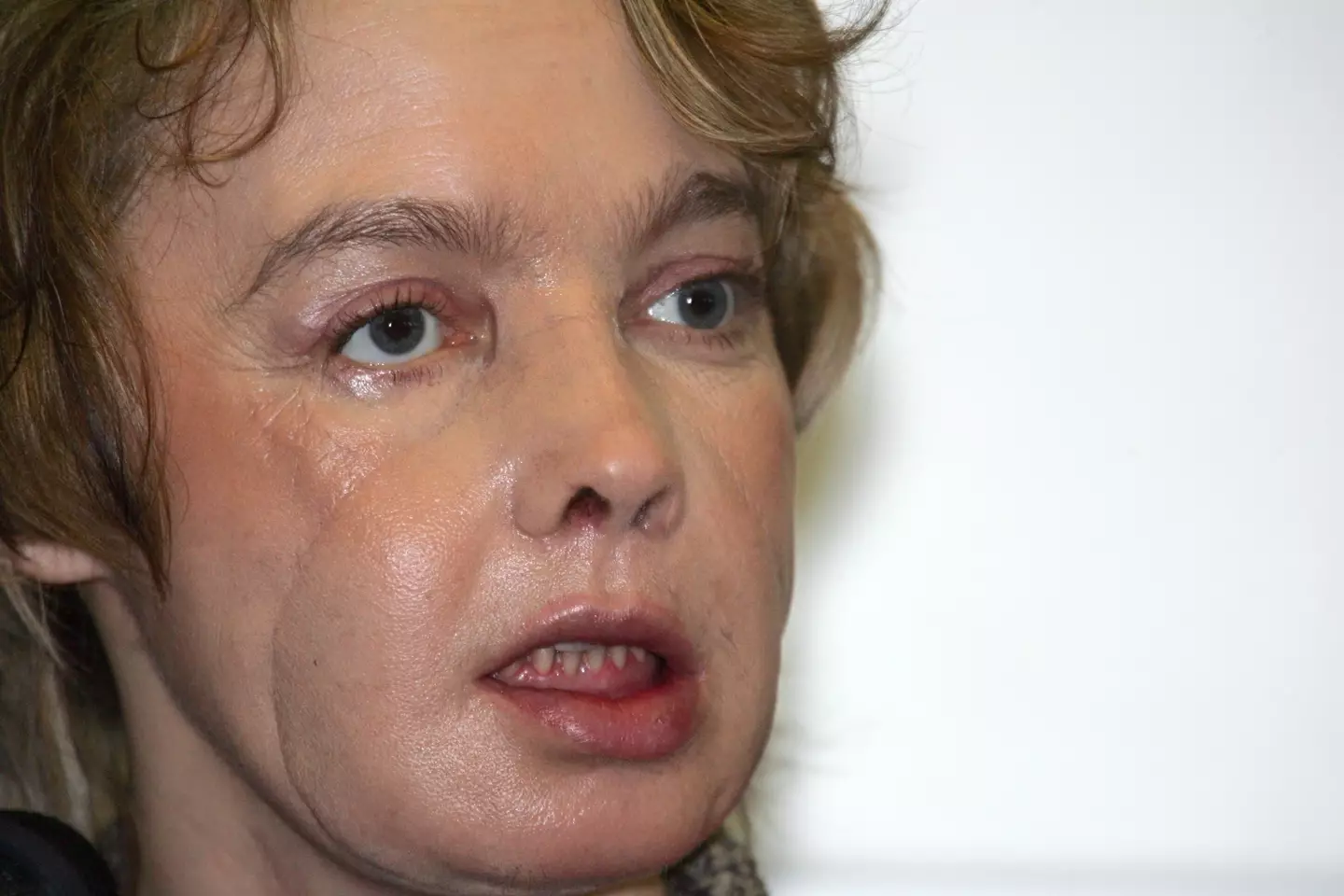 Isabelle Dinoire got the world's first face transplant in 2009.