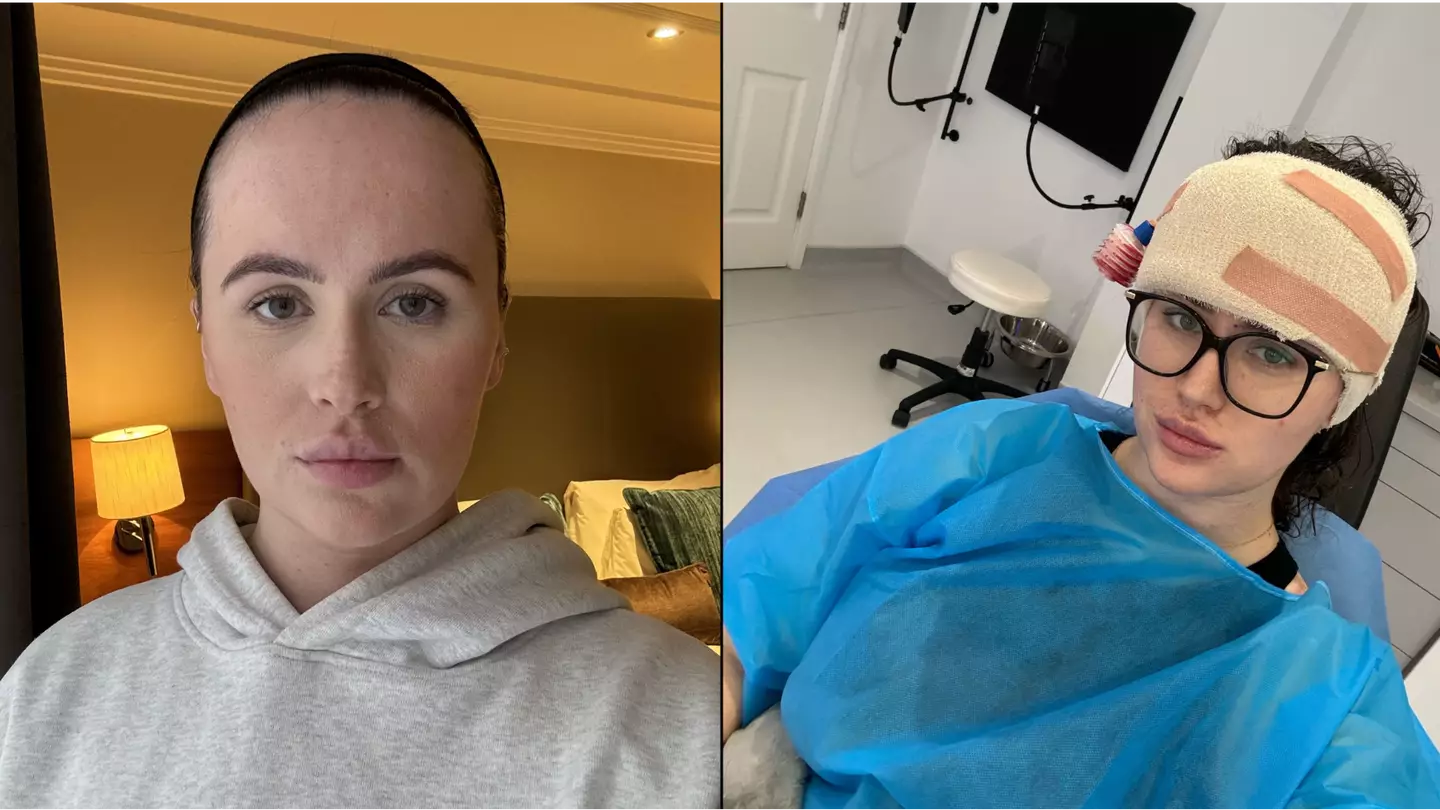 Woman called 'fivehead' by cruel bullies gets £9,000 forehead reduction surgery