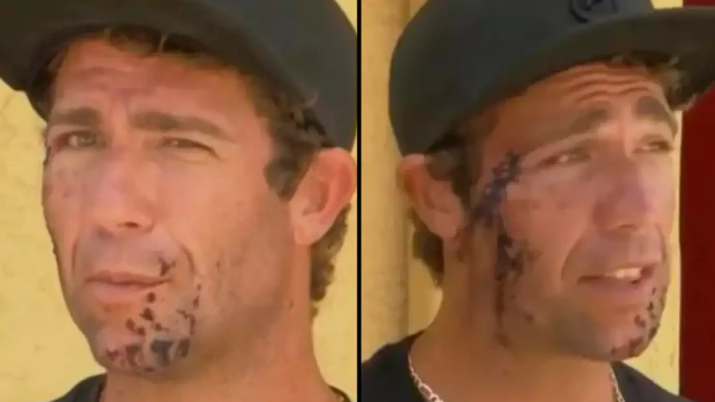 Man heard terrifying ‘crunch’ when shark bit into his face in ‘scariest moment’ of his life