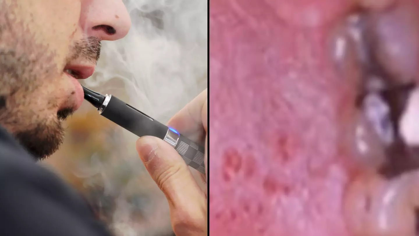 Dentist shows red spots which form in blind spot when you vape