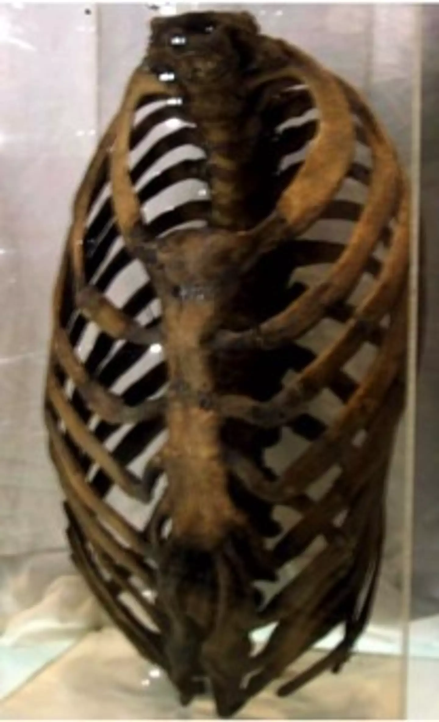 The ribcage of a lifelong corseting woman (Royal College of Surgeons)