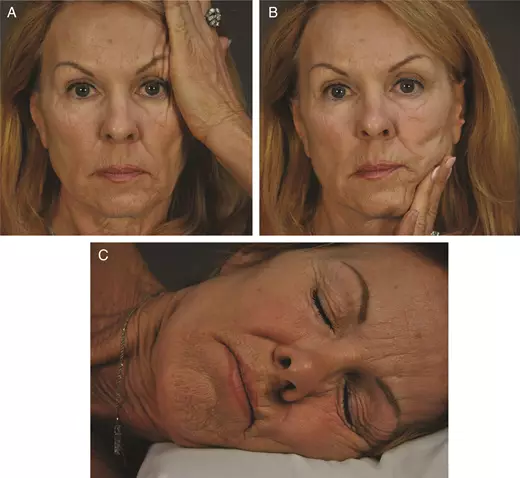 Study Shows Stomach And Side Sleeping Positions Cause Facial Distortion And  Wrinkles Over Time