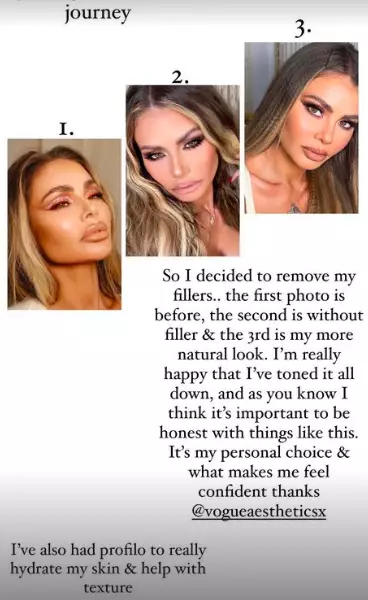 Chloe Sims has revealed her natural look on Instagram, after having her facial fillers removed (