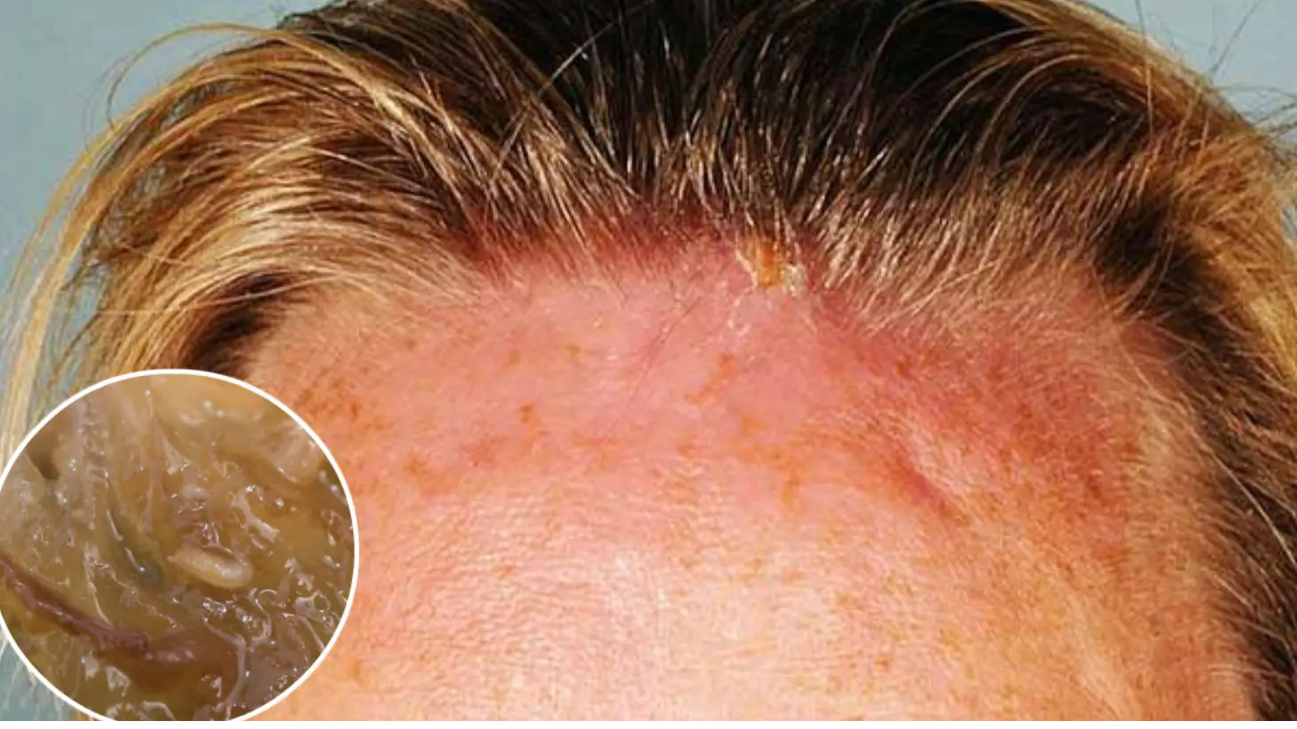 Woman Visits Doctor With Swollen Head And Two Maggots Are Dug Out