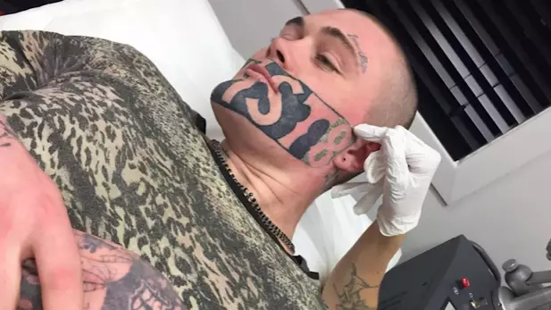 Man With Massive ‘Devast8’ Face Tattoo Finally Gets It Lasered Off 