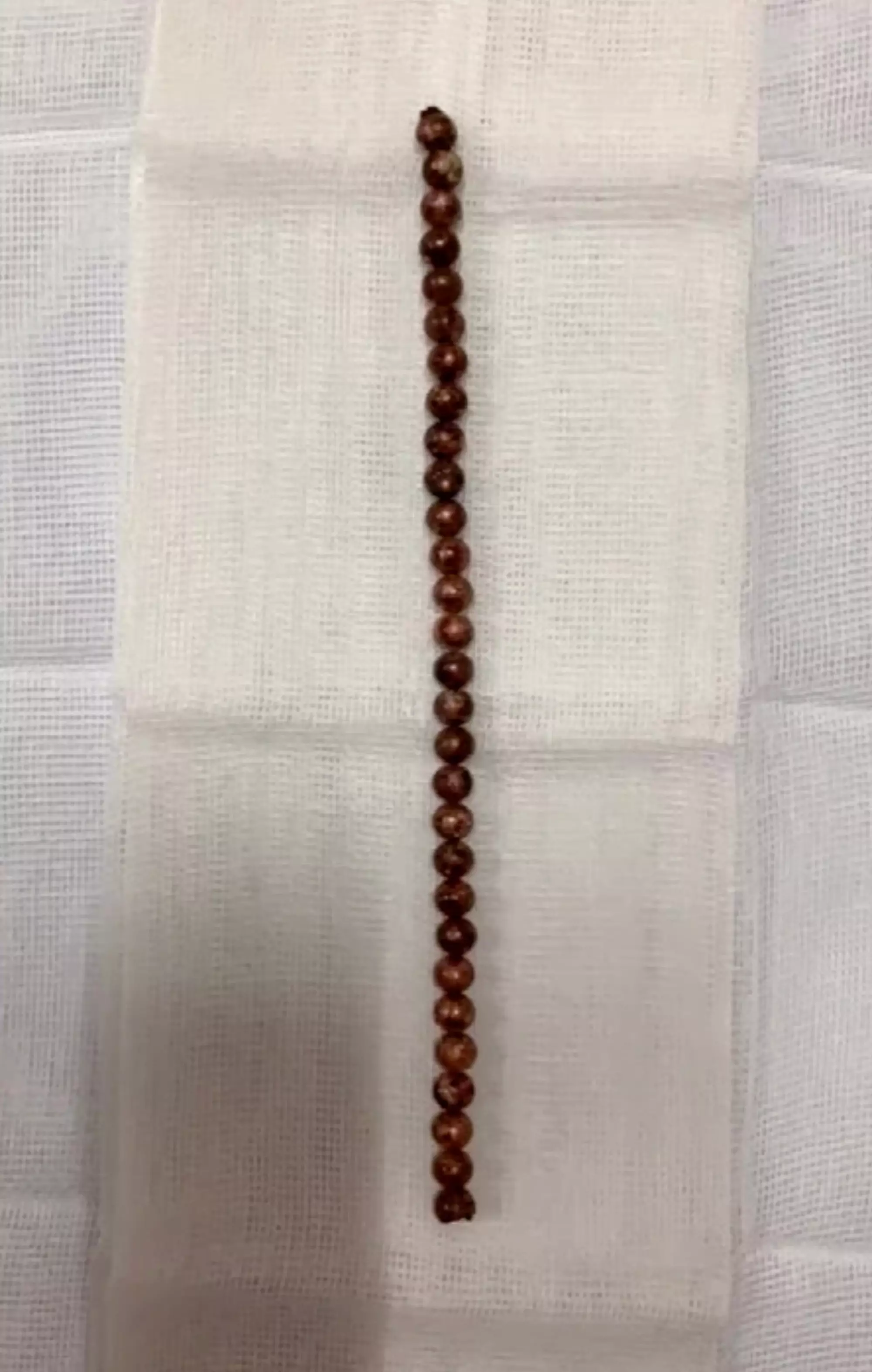 Doctors removed 29 magnetic balls from the young boy's bladder.