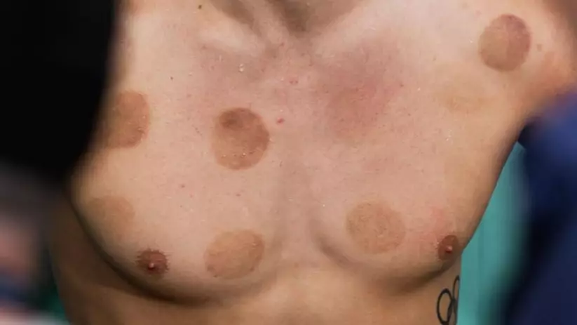 Reason Why Some Olympic Athletes Have Dark, Circular Welts On Their Bodies