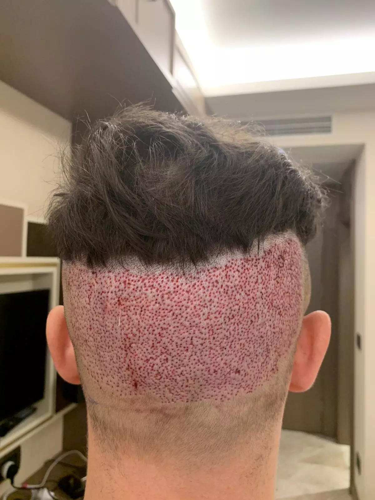 Surgeons, he says, took too much from the back, leaving him with a bald patch.