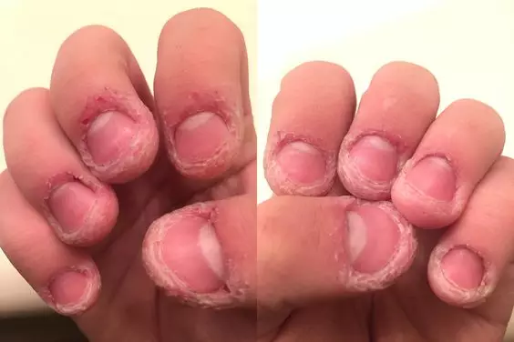Why You Shouldn't Bite Or Pick The Skin Around Your Finger Nails