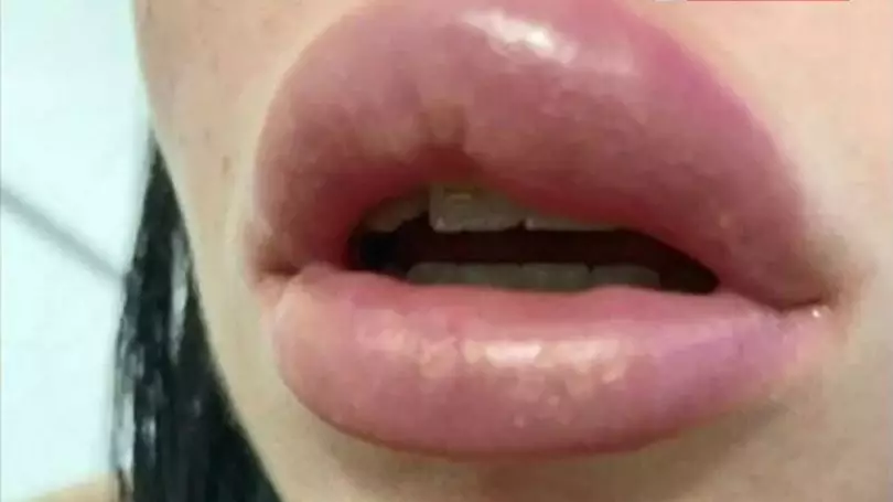 Australian Woman Nearly Blinded After Lip Filler Procedure Goes Badly Wrong