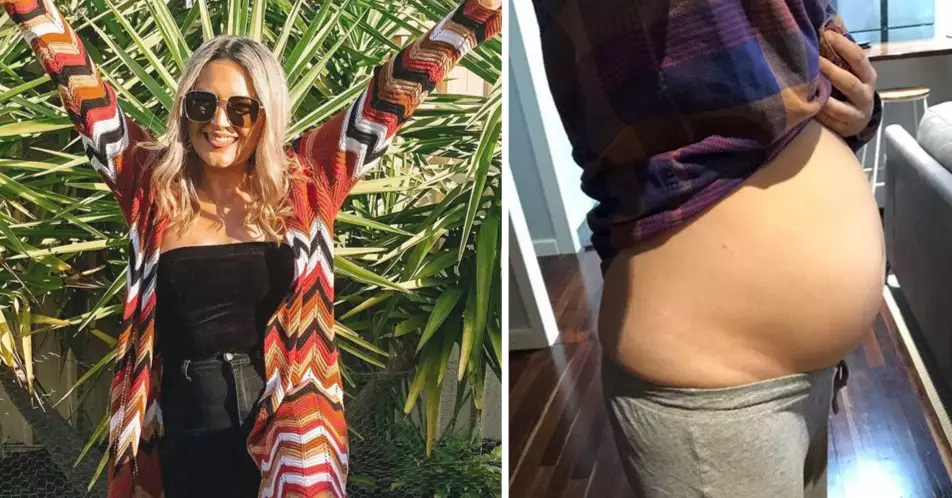Woman Says Bloating From Endometriosis Caused People To Think She Was Pregnant