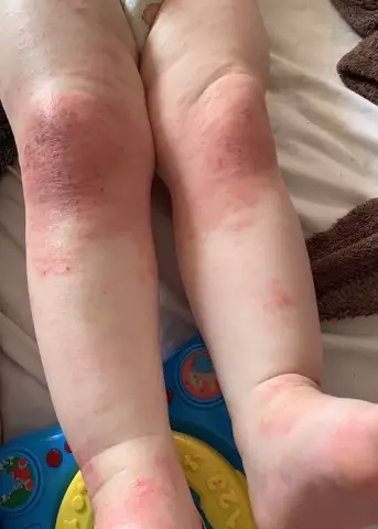Grace Axall has suffered with eczema flare-ups since she was a baby (