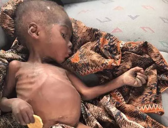 The Starving 'Witch' Boy Is On The Road To Recovery