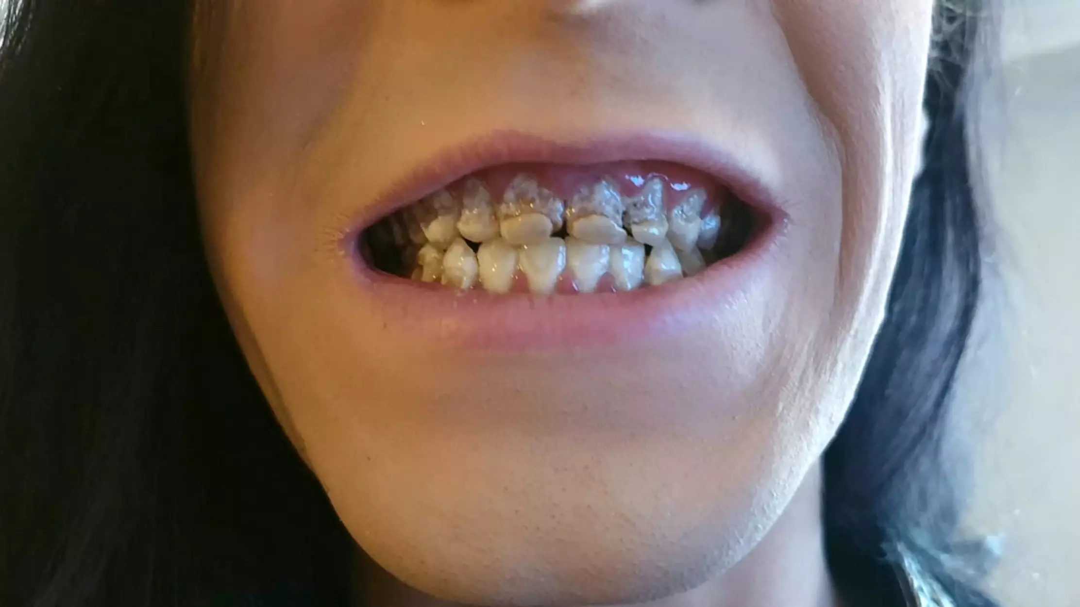This Is The Damage Six Cans Of Energy Drink A Day Can Do To Your Teeth