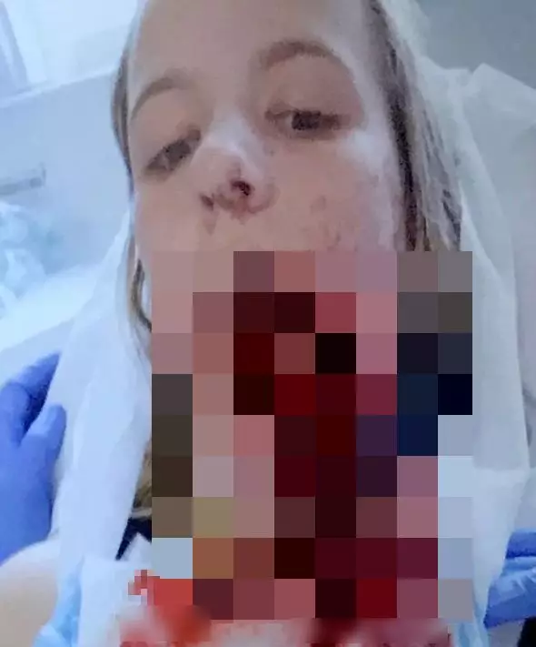 The teenager's jaw split in half after she fell from her horse and smashed her face into a gatepost.
