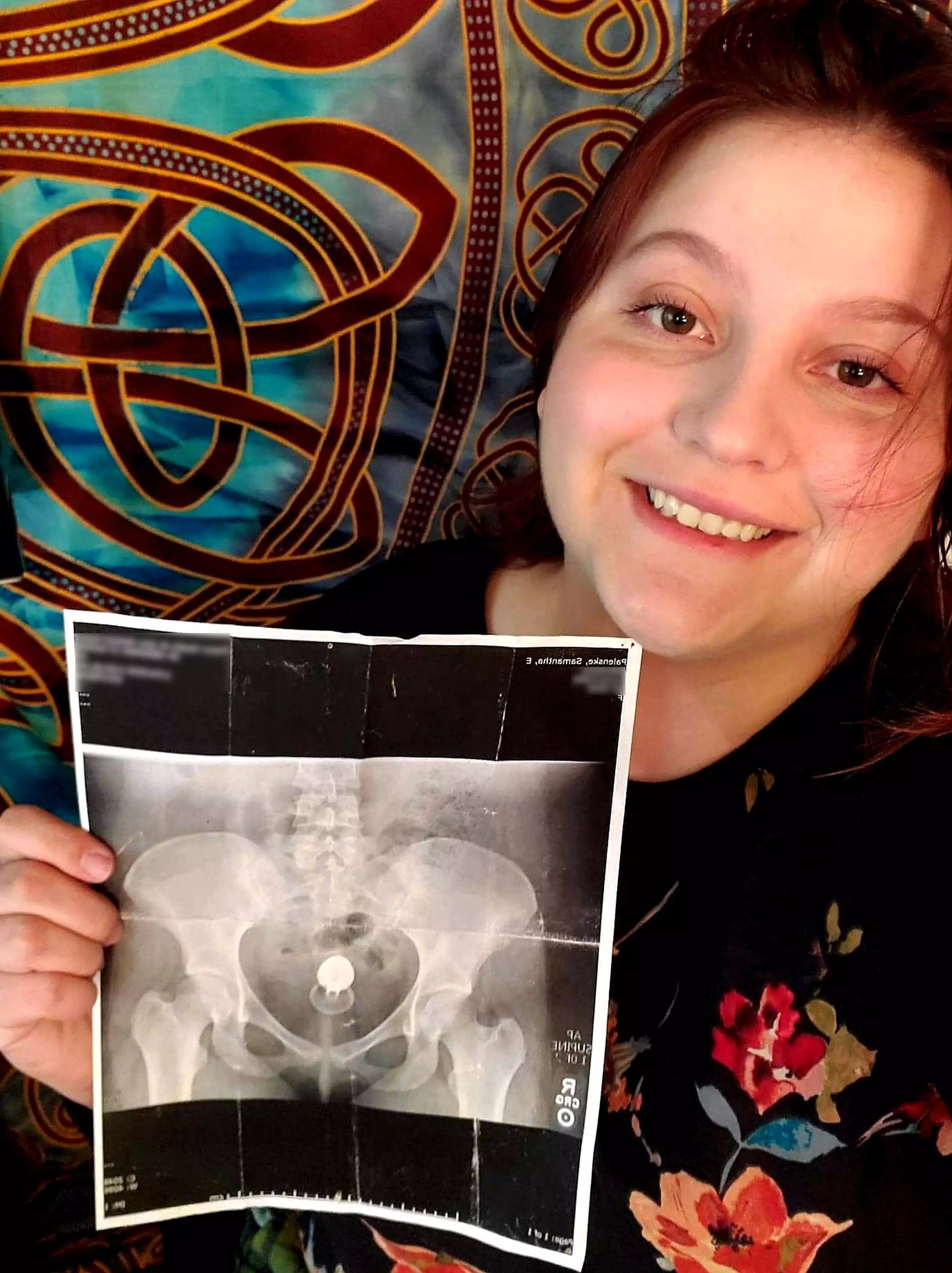 Samantha proudly posing with a print out of her x-ray...